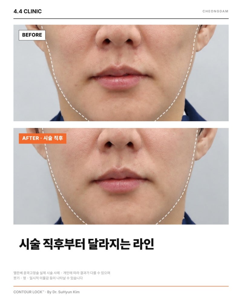 리프팅 후 라인이 다시 무너지는 이유, 엘란쎄 윤곽고정술 컨투어락(CONTOUR LOCK™) | 청담 4.4 CLINIC 사진 2